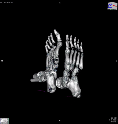 Foot MRI Animation – Horos